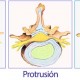 Protusion. Hernia discal